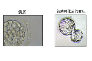 试管辅助孵化