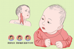 婴儿斜颈