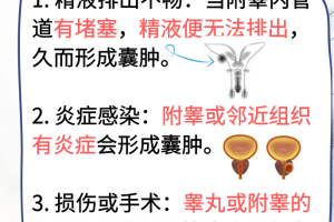 右侧附睾囊肿