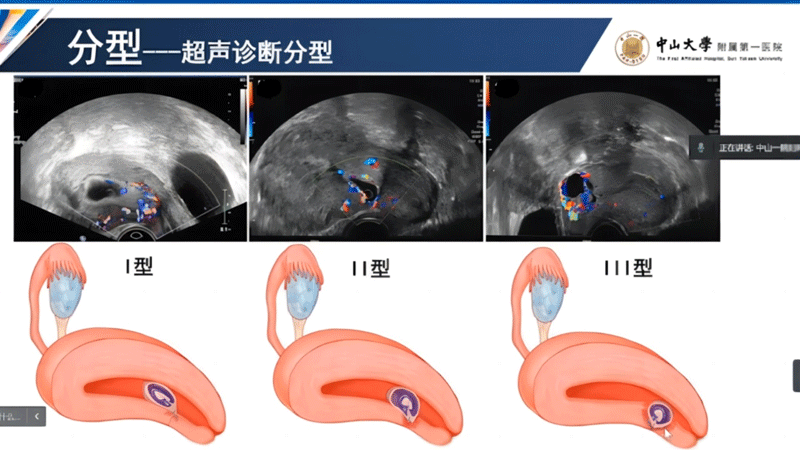 瘢痕妊娠