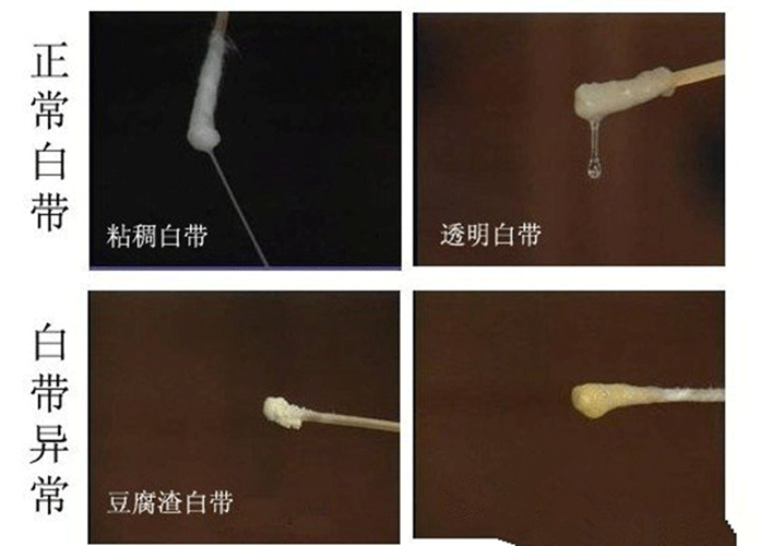 白带常规