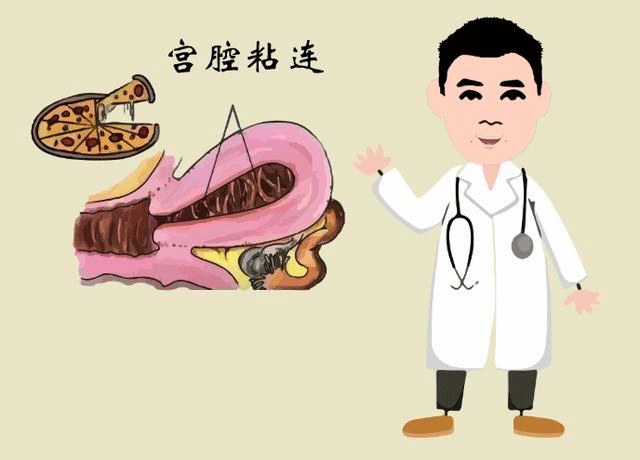 宫腔粘连
