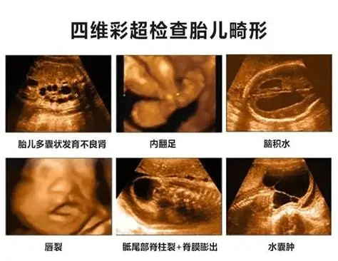 四维彩超