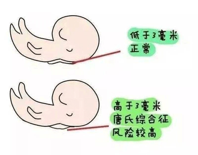 胎儿nt检查